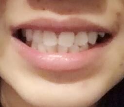 牙齿整形美容冠