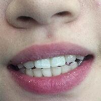 氧化锆烤瓷牙价格5600元两颗，果很满意