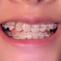 牙齿正畸矫正一年费用10000元