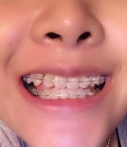 牙齿正畸矫正价格