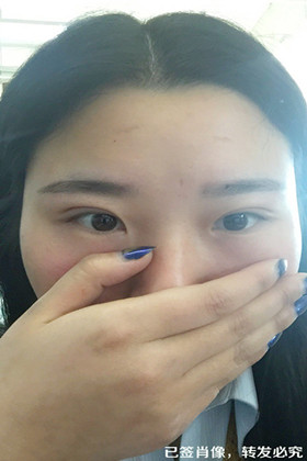 刚做了双眼皮切开重睑手术，恢复得越来越自然了