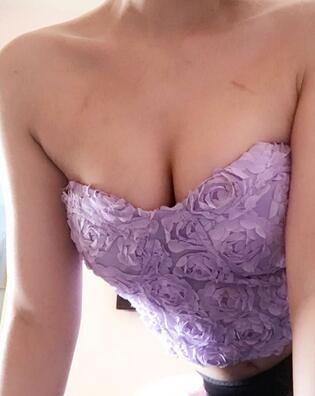 自体脂肪丰胸对比图 抽脂隆胸十天