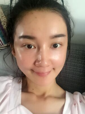 干瘪的脸在自体脂肪面部填充后巨饱满