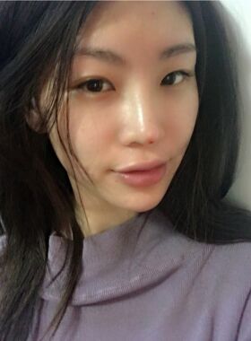 线D隆鼻恢复过程图，看看我的果怎么样