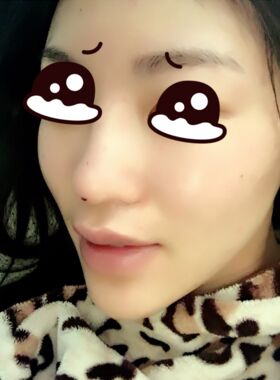 线D隆鼻恢复过程图，看看我的果怎么样