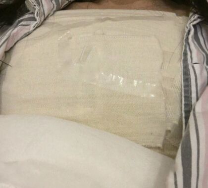 来看看我做的花样年华假体隆胸果怎么样