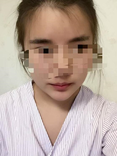 磨骨手术让我变成小v脸 果真的很不错