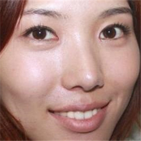 武汉希思特做了埋线法双眼皮、开内眼角和鼻尖移植软骨整形手术~