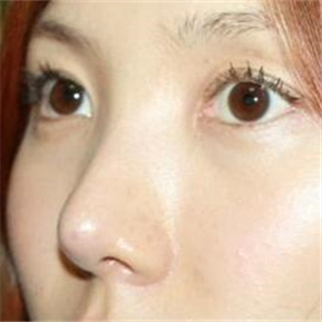 武汉希思特做了埋线法双眼皮、开内眼角和鼻尖移植软骨整形手术~