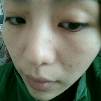 光子嫩肤和下巴脂肪填充术后果图片分享，董萍门诊做的~