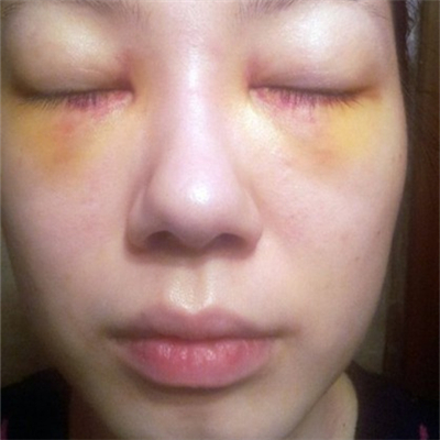 激光溶脂去眼袋恢复过程和前后对比果图片分享哦~