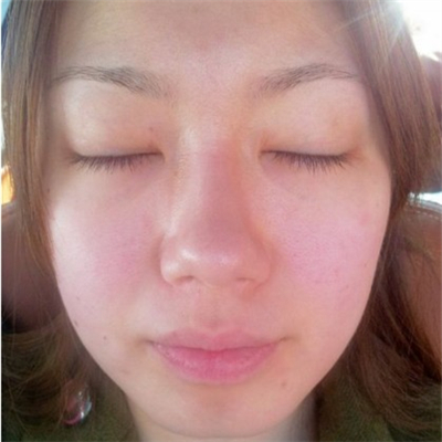 激光溶脂去眼袋恢复过程和前后对比果图片分享哦~