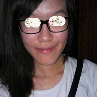 激光祛痘手术恢复过程分享，还有前后对比果图片哦~