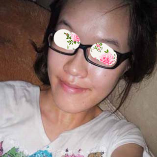 激光祛痘手术恢复过程分享，还有前后对比果图片哦~