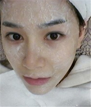 元旦做的光子嫩肤，分享恢复过程和前后对比果照片哦~