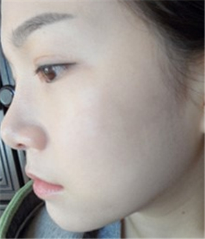 元旦做的光子嫩肤，分享恢复过程和前后对比果照片哦~