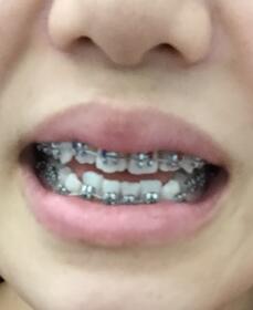 口腔正畸缓解图片