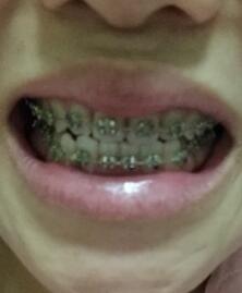 口腔正畸图片