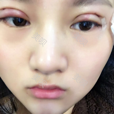 一个月时间的切开双眼皮消肿过程图分享