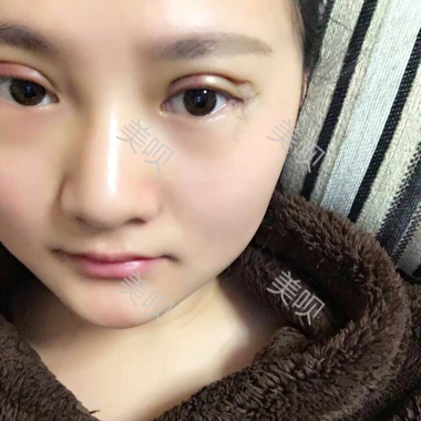 一个月时间的切开双眼皮消肿过程图分享