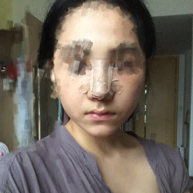 歪鼻矫正手术前后过程以及恢复照片对比照