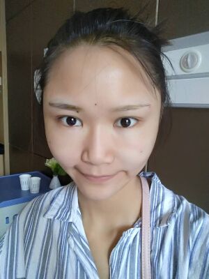 自体脂肪面部填充后恢复，成活率还蛮高的