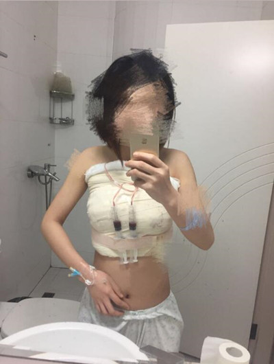 假体隆胸拯救了我的小平胸 快来看看我的果怎么样