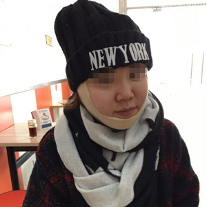 吸脂瘦脸手术半年了，分享前后对比果照片~