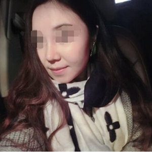 吸脂瘦脸手术半年了，分享前后对比果照片~