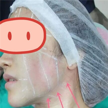 做音波拉皮除皱术一个月了，分享恢复过程和前后对比果图片~