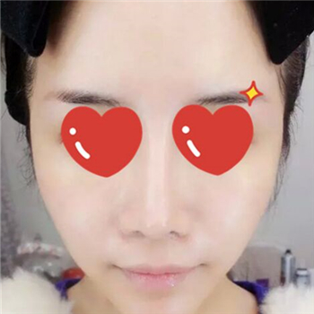 做音波拉皮除皱术一个月了，分享恢复过程和前后对比果图片~