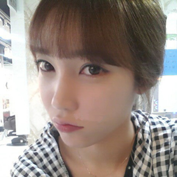 长沙美莱做了磨颧骨手术，分享恢复过程和前后对比果图片~