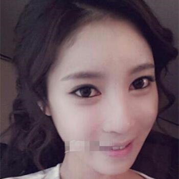 长沙美莱做了磨颧骨手术，分享恢复过程和前后对比果图片~