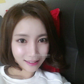 长沙美莱做了磨颧骨手术，分享恢复过程和前后对比果图片~