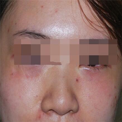 内切去眼袋手术恢复过程和前后对比果图片分享，美联臣做的哦~