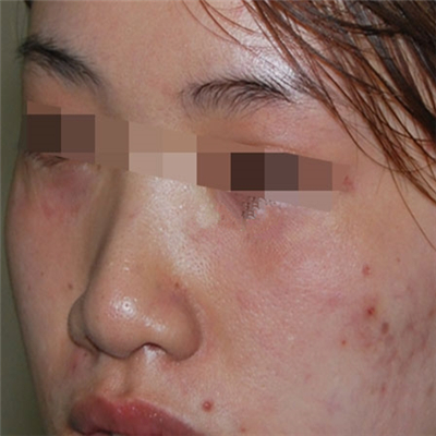 内切去眼袋手术恢复过程和前后对比果图片分享，美联臣做的哦~