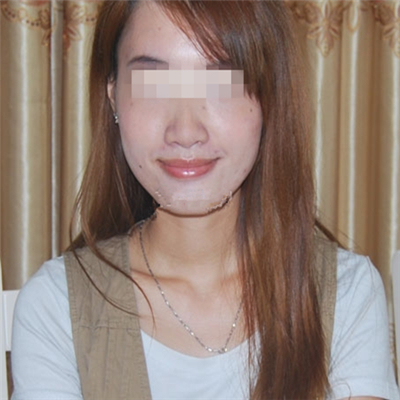 内切去眼袋手术恢复过程和前后对比果图片分享，美联臣做的哦~