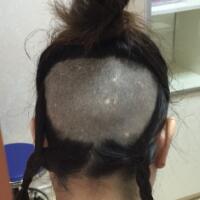 在雍禾植发医院做微创微创植发经历分享，植发果很好