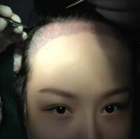 在雍禾植发医院做微创微创植发经历分享，植发果很好