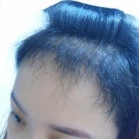 在雍禾植发医院做微创微创植发经历分享，植发果很好