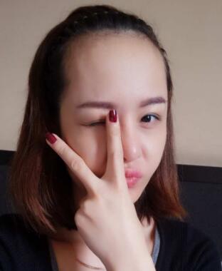 植发可以改良发际线