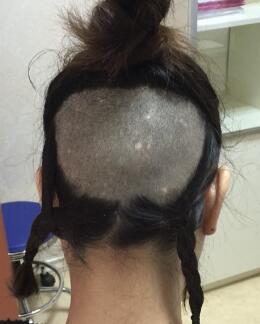 植发前提取后脑健康毛囊部位