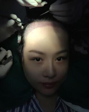 植发手术，将健康毛发组织移植到前额