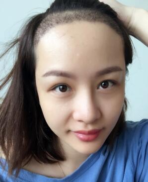 植发，种发际线真实案例分享