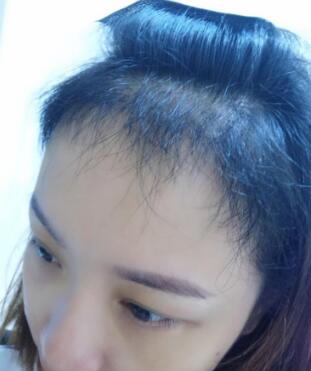 植发有五个月了