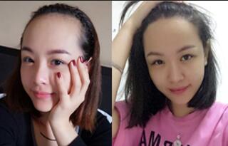 植发前后对比图,种发际线