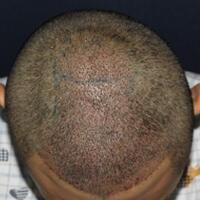 北京微创植发价格23800元，植发过程多图对比分享