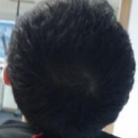 北京微创植发价格23800元，植发过程多图对比分享