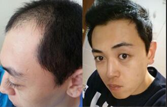 植发前后对比图