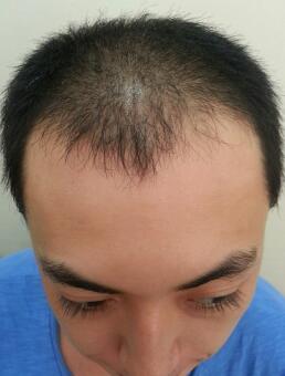 植发前，头顶头发变得稀疏，额头前开始呈现M型